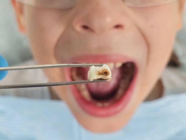 Best Emergency Treatment for Toothache in Torrance, CA
